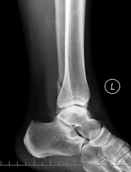 a (e) diagnostika a postup při poranění mediálního osteoligamentózního komplexu. Správná klasifikace a korektní interpretace typu poranění Nejčastěji používaná klasifikace je Weberova (52).