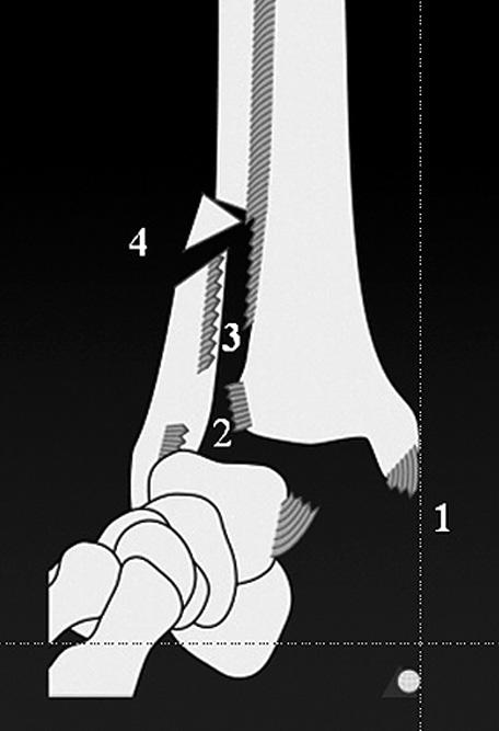 542/ Obr. 3. Schematické znázornění poranění hlezna v pro naci se zevní rotací nohy (Weber C).