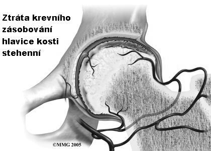 Obr. 2 - Znázornění ztráty krevního zásobení (44). Obr. 3 Krevní zásobení hlavice kosti stehenní (37).