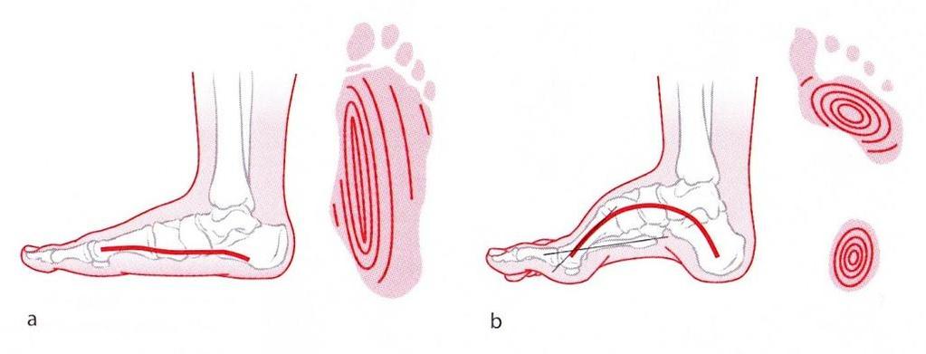 Obr. 25 Podélná klenba nohy 114 a) Zploštělá u plochovbočené nohy, b) zvýšená u nadměrně vyklenuté nohy.