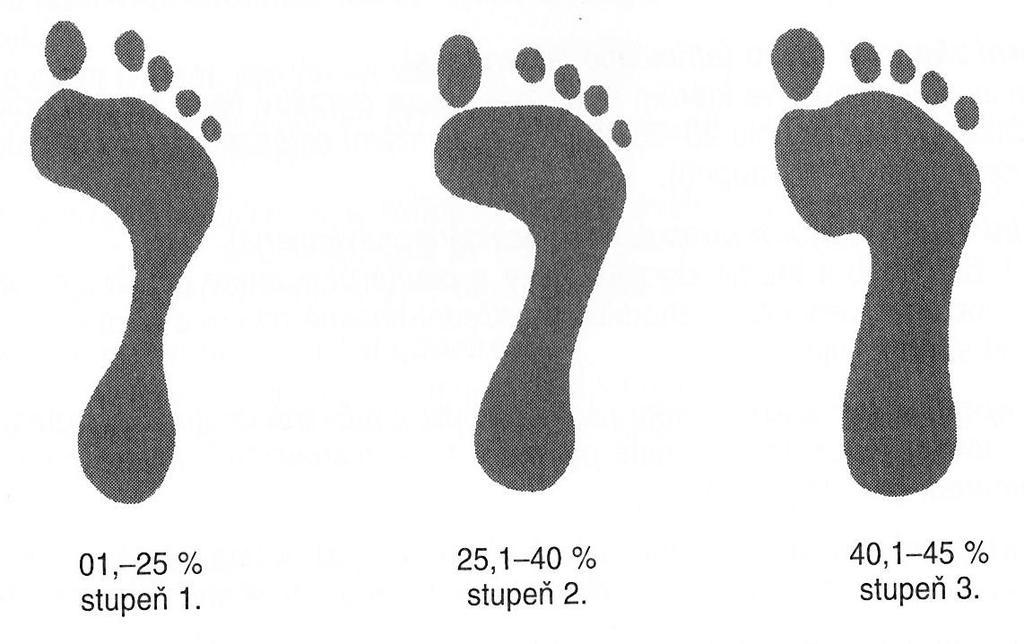 Obr. 26 Plantogramy chodidla podle stupně plochonoží 115 115 NOVOTNÁ, Hana.