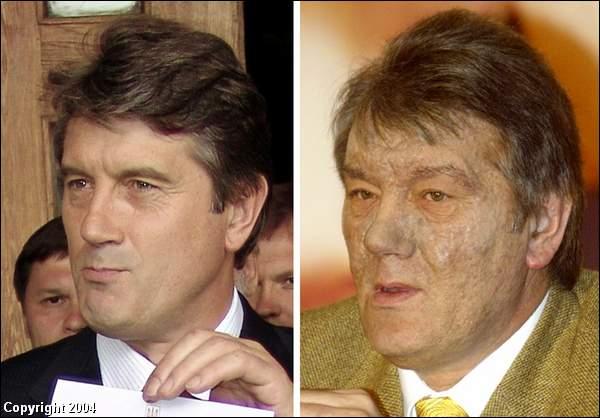 Chlorakne Viktor Yushchenko - before and after
