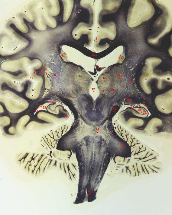 Frontální řez přes CGL 1-INSULA 2-CAPSULA EXTREMA 3-CLAUSTRUM 4-CAPSULA EXTERNA 5-PUTAMEN 6-NCL. CAUDATUS 7-CAUDA NUCLEI CAUDATI 8-CAPSULA INTERNA 9-GYRUS CINGULI 10-CORPUS CALLOSUM 11-FORNIX 12-III.