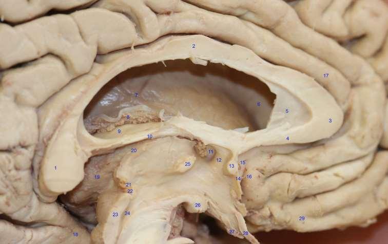 1-splenium corporis callosi 2-truncus corporis callosi 3-genu corporis callosi 4-rostrum corporis callosi 5-septum pellucidum 6-nukleus caudatus 7-v.