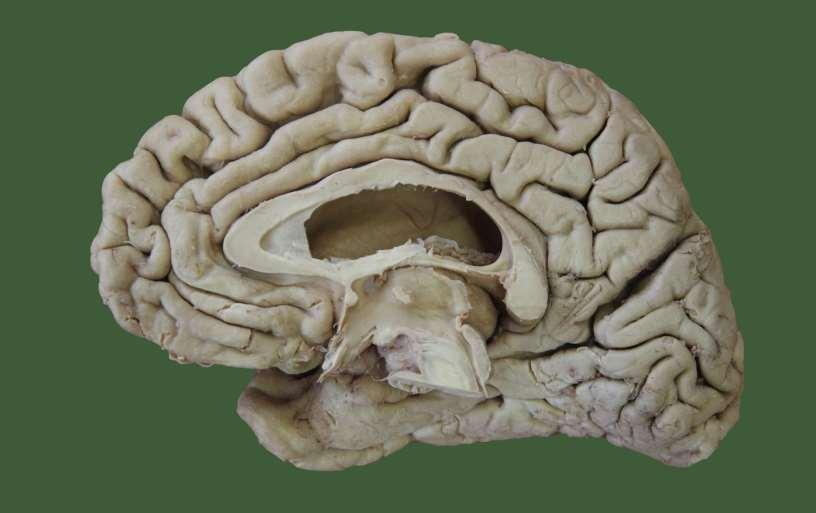 4 3 SPe CC Cau 5 2 Th 6 1 11 10 CC- corpus callosum Spe septum pellucidum Cau nucleus caudatus 9 8 7 1- lamina terminalis 2-commisura anterior 3-fornix 4-stria