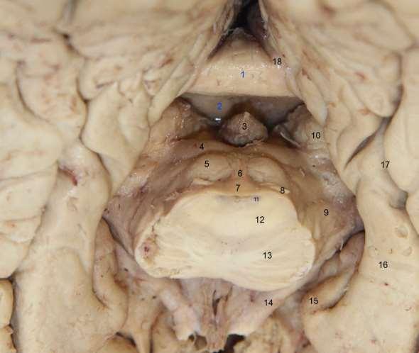 Řez pontomesencephalickým přechodem pohled do fisura telodiencephalica 1- corpus callosum splenium 2-commissura fornicis 3-epiphysis cerebri 4-colliculus superior 5-colliculus inferior 6-frenulum