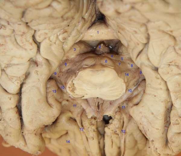 Řez pontomesencephalickým přechodem pohled do fisura telodiencephalica 1- corpus callosum splenium 2-epiphysis cerebri 3-pulvinar thalami 4-colliculus superior 5-brachium colliculis sup 6-colliculus