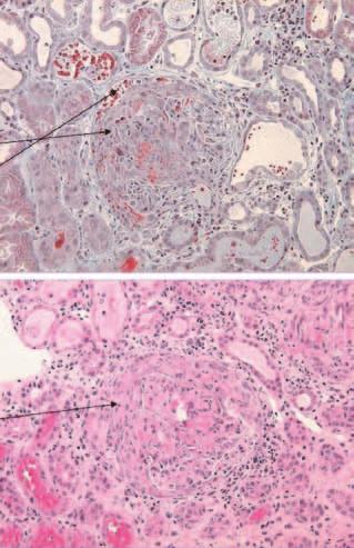 Polyangiitis microscopica vzácná nekrotizující vaskulitida histologickým nálezem při optické mikroskopii (glomeruly jsou různou měrou poškozené, sklerotické) a prakticky negativním (pauci-imunním)