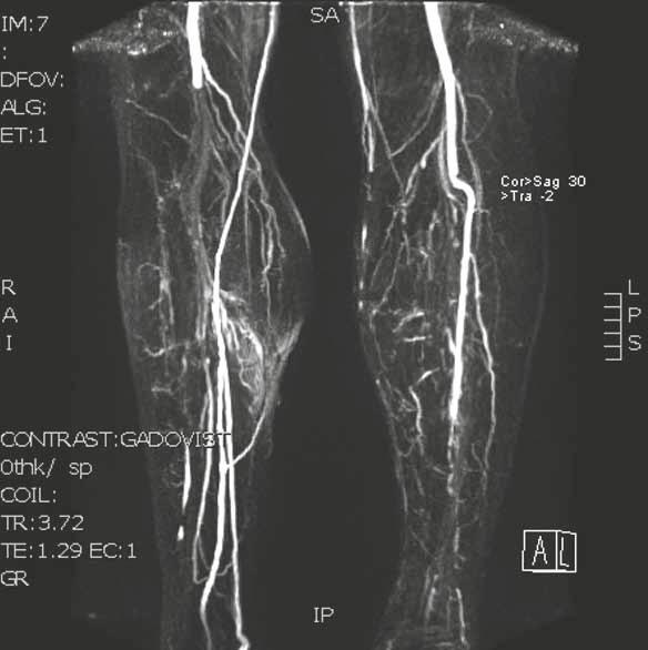 č. 2: MR angiografie tepen dolních končetin PDK: AP distálně uzavřena, bez AAP.