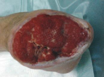 Pacient s kritickou ischemií levé dolní končetiny Foto: archiv autorky Obr. č. 5: Čistý defekt s epitelizací (září 2013) ký holter.