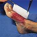 entering the wound.