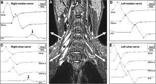 anti GM1 IgM Zobrazení magnetickou rezonancí prokazující