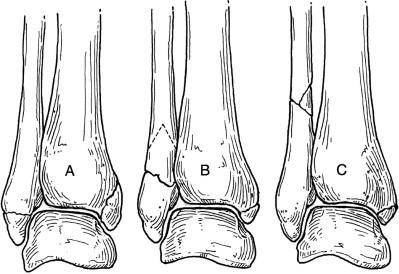 2.4.5 TYPY OSTEOSYNTÉZ Osteosyntézy se dělí podle užitého materiálu, způsobu aplikace a místa lokalizace na: Úhlově stabilní dlaha neboli LCP (Locking Compression Plate) pevnější než klasická dlaha a