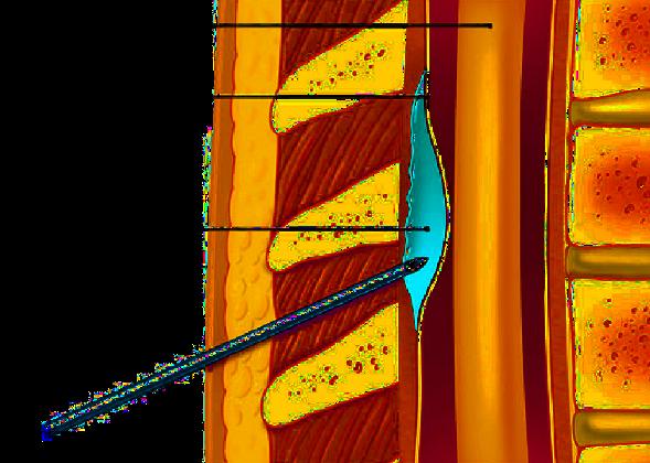 Epidurální blokáda EPI prostor mezi mater dura a