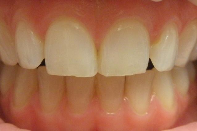 1.3 Zdravá gingiva Zdravá gingiva má růžovo-bílou barvu, není oteklá a nemá prosvítající krevní kapiláry.