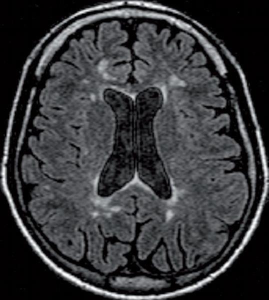 Příloha 2 Ložiska v bíle hmotě mozku pacienta s roztroušenou sklerózou Zdroj: Roztroušená skleróza, neuromyelitis optica a antifosfolipidový syndrom z diferenciálnědiagnostického pohledu neurologa.