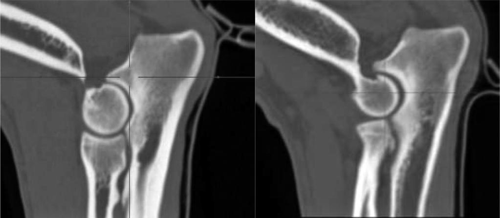 301/ Acta Chir Orthop Traumatol Cech. 84, 2017, No. 4 PŮVODNÍ PRÁCE Obr. 2. Subjektivně byla hodnocena HUI podle šířky kloubní štěrbiny v nejvyšším kaudálním vyklenutí kladkového zářezu ulny.