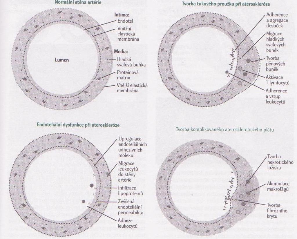5: Proces aterogeneze a vývoj