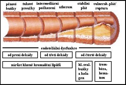 Léze typu IV (ateromy): Při nahromadění extracelulárních lipidů a rozpadu pěnových buněk vzniká lipidové jádro, obsahující krystaly cholesterolu a depozity kalcia.