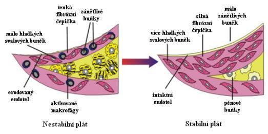 3.4 Stabilita aterosklerotického plátu Typický plát (aterom, fibrózní plát) obsahuje lipidové nebo nekrotické jádro kryté fibrózní vrstvou tzv. čepičkou.