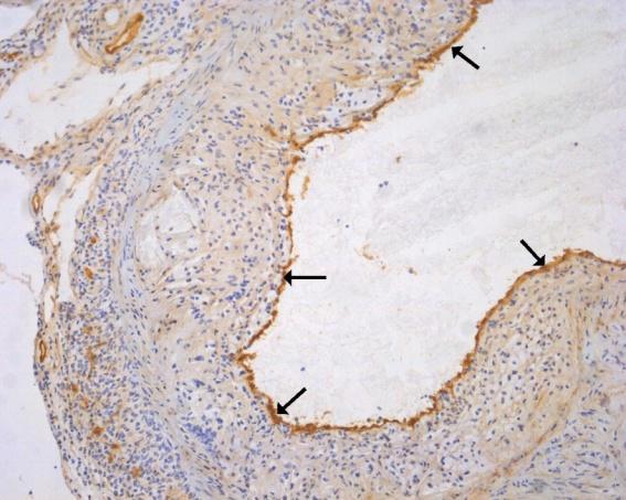 Obrázek 12: Příklad imunohistochemického barvení endoglinu v 16 týdenní hyperchol.