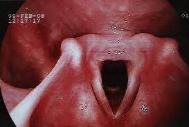 - adenoidní vegetace na zadní stěně - ústí zde Eustachova trubice orofarynx od měkkého patra