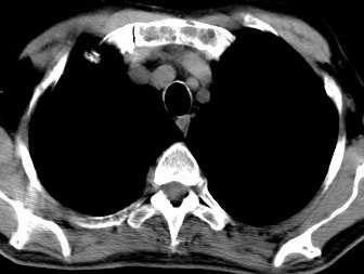 kortikalis MRI vyšetření patrna