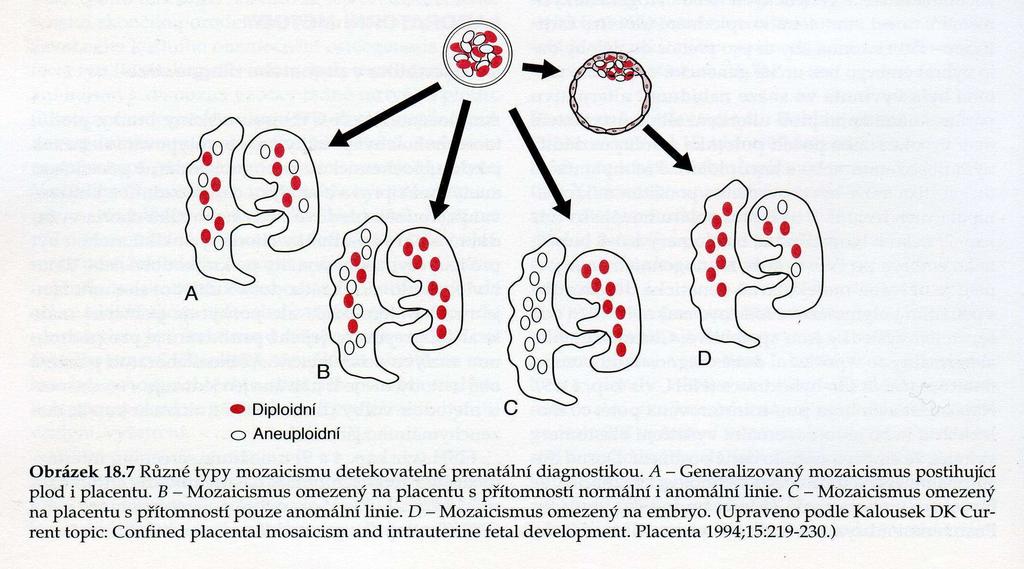 VROZENÉ CHROMOSOMOVÉ ABERACE (VCA) MOZAICISMUS prenatální diagnostika INVAZIVNÍ METODY PRENATÁLNÍ DIAGNOSTIKY pravý mozaicismus u choriových klků Obr.