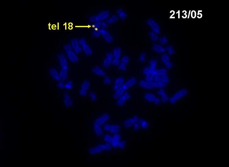 FISH: del tel 18q nebalancovaná chromosomová přestavba Chybění druhého signálu