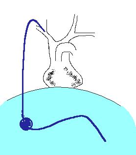 Peritoneovenozní spojka LeVeenův - spontánní gradient (4mmHg) Denverský shunt ( aktivní