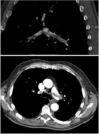 Potvrzení diagnózy PE Zobrazovací metody : CT plicní angiogram