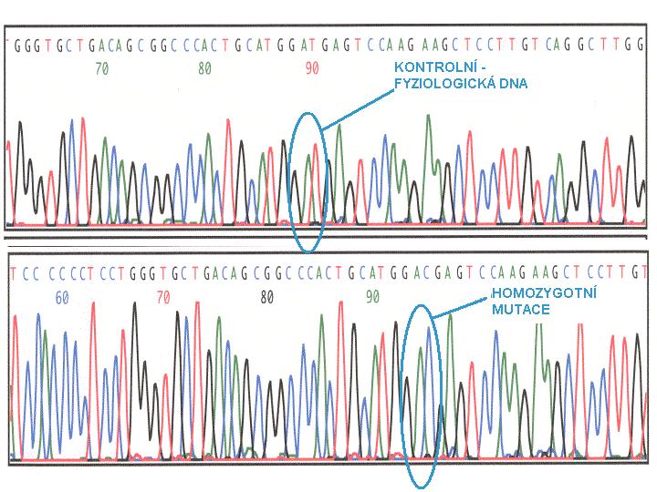 Protein C Mutace v homozygotní konstituci T->C => GAT->GAC =>