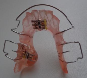 (zdroj:obrázek autorky) Obrázek 9 Dolní deska s laterálními nákusnými valy přes okluzní plochy laterálních zubů a dvěma