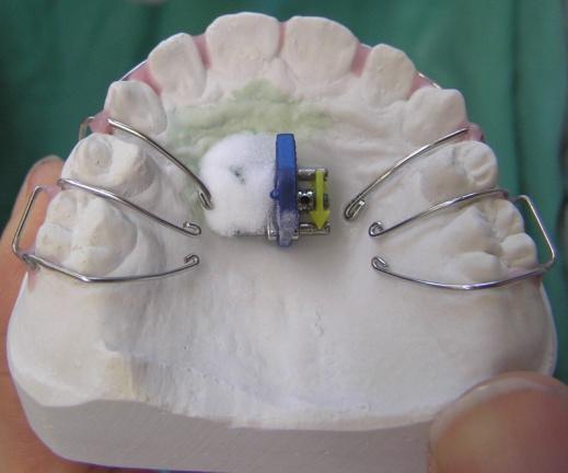 5.4 Zhotovení báze V další laboratorní fázi budeme zhotovovat bázi ortodontického aparátu. Nejprve se musí model izolovat. Izolaci provedeme ponořením modelu do vody.