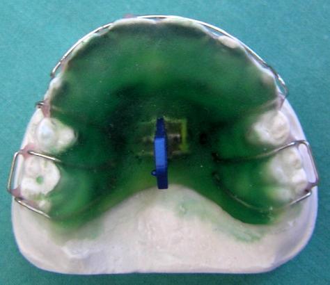 Obrázek 47 Polymerovaná báze ortodontického aparátu (zdroj:obrázek autorky) Obrázek 48 Brousky