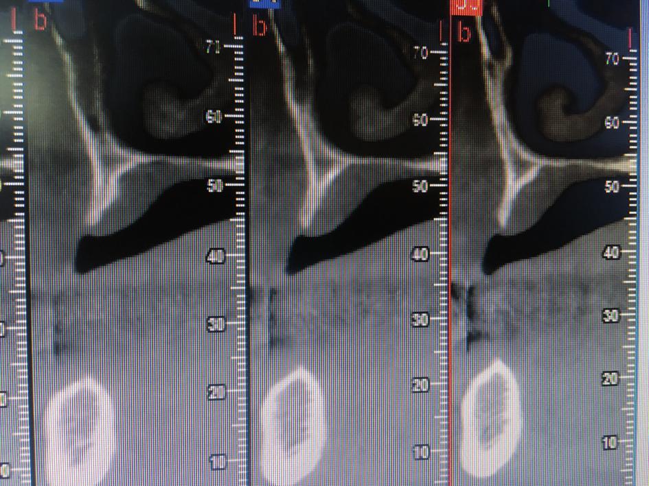 Obr. 3 Obr. 4 Obr. 3, 4: Multiplanární řez Obr. 5 Obr. 5: Data v programu CoDiagnostics Obr.