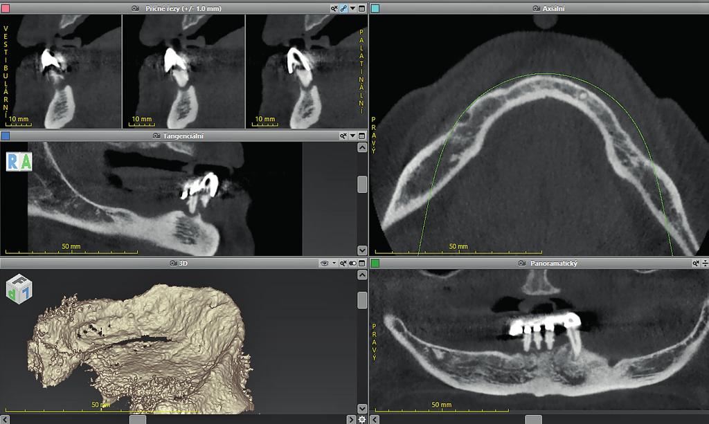 Při analýze CBCT bylo třeba brát velký důraz na biomechanickou strukturu kosti, podle níž byl navržen speciﬁcký tvar