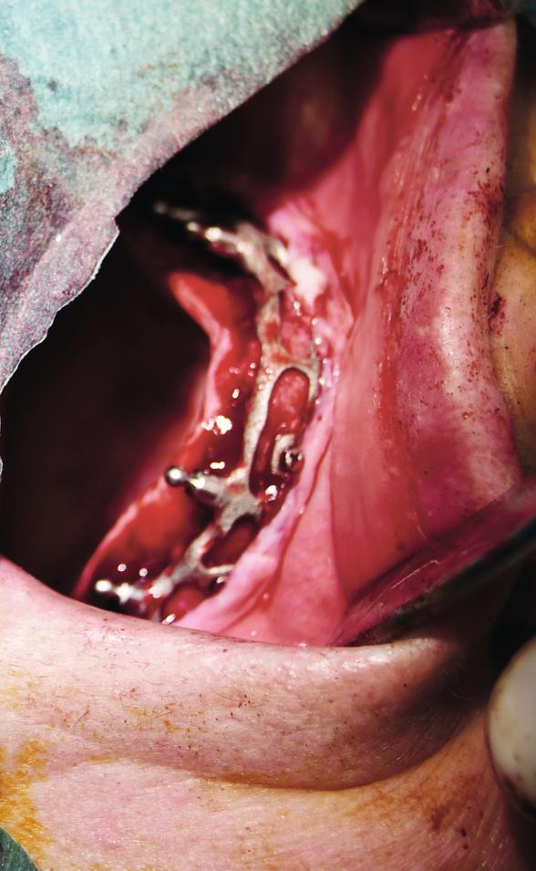 Obr. 19 Obr. 19: Operační fáze: inzerovaný SPI ﬁxovaný mikrošroubky do kosti V nejtenčí části dosahoval implantát tloušťky 0,52 mm. I přes tuto tloušťku byl SPI absolutně rigidní.