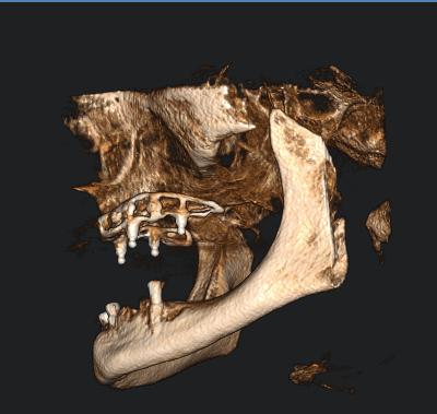 Po opatrném odseparování mukoperiostu vestibulárně a palatinálně s ohledem na nervově-cévní struktury byla jemně upravena kost podle 3D modelu maxily.