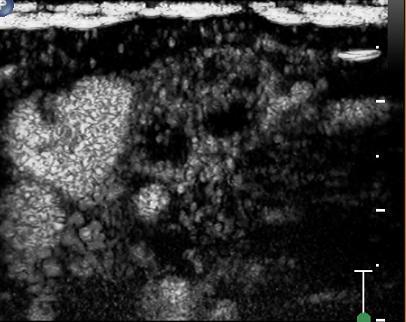 Přehled histologických nálezů uzlin postižených primárními a sekundárními nádorovými procesy je uveden v tabulce 11 a 13.