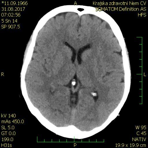 31.8.2017 v 7:15 podána tpa 1.9.2017 NIHSS (24 hod.) = 4 body 1.9.2017 kontrolní CT vyšetření mozku ischemie T-O vpravo 5.