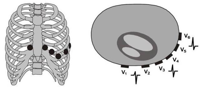 z dalších šesti úhlů. Elektrody na hrudní stěně jsou rozmístěny následovně: V1- ve 4.