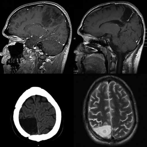 Obr. 3. 29letý pacient po radikální > 90% resekci oligodendrogliomu gr. II v oblasti gyrus postcentralis, lobulus parietalis superior a corpus callosum vpravo v roce 2006. Obr. 4.