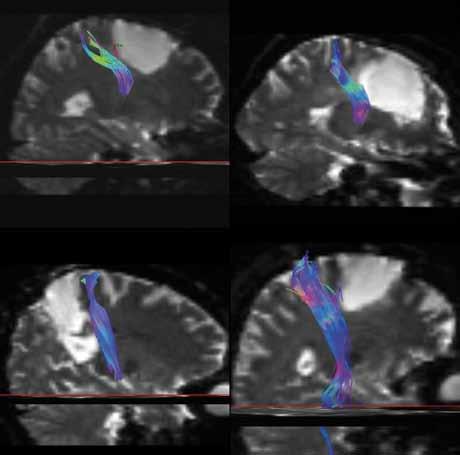 90% radikality s přijatelnou neurologickou morbiditou. Obr. 5. Traktografie pyramidové dráhy všech graficky dokumentovaných pacientů pacienti popsaní v obr.