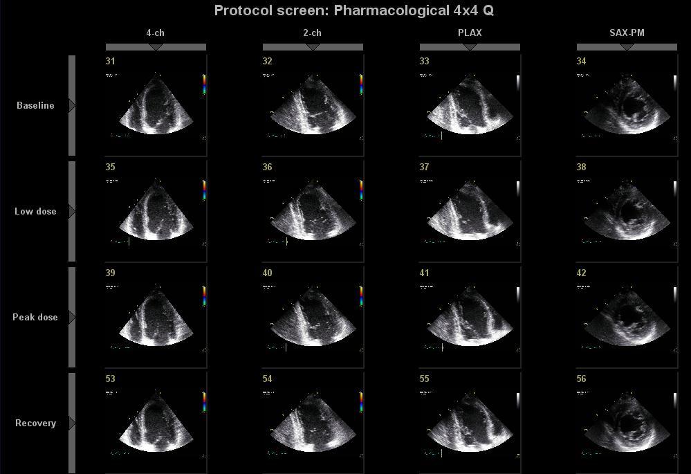 3.13 Dobutaminová echokardiografie Tato metoda sloužila k detekci viability hibernovaného myokardu, kdy po aplikaci malých dávek dobutaminu (5, 10 ug/kg/min) bylo zjišťováno zda dochází ke zlepšení