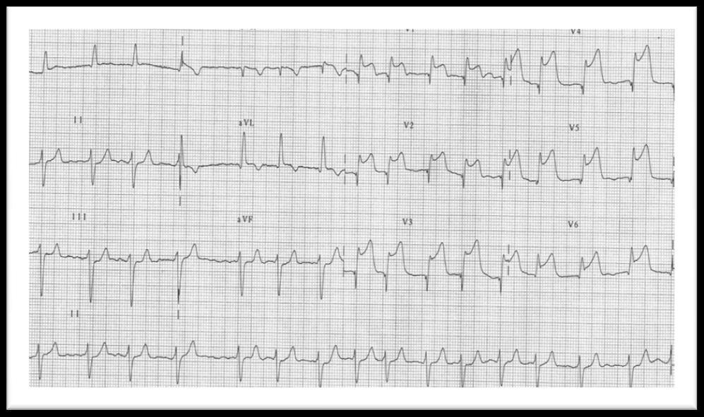 1 Úvod 1.1 Akutní infarkt myokardu s ST elevacemi Akutní infarkt myokardu s ST elevacemi (STEMI) je dynamický, komplexně probíhající proces, při kterém dochází k omezení až přerušení perfuze myokardu.