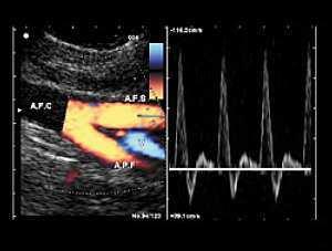3. Vyšetření cév ultrazvukem možnost rozpoznat směr krevního toku.