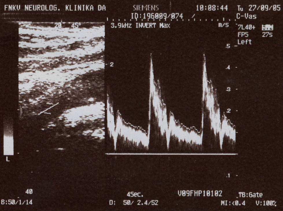 3. Vyšetření cév ultrazvukem Obr. 3.