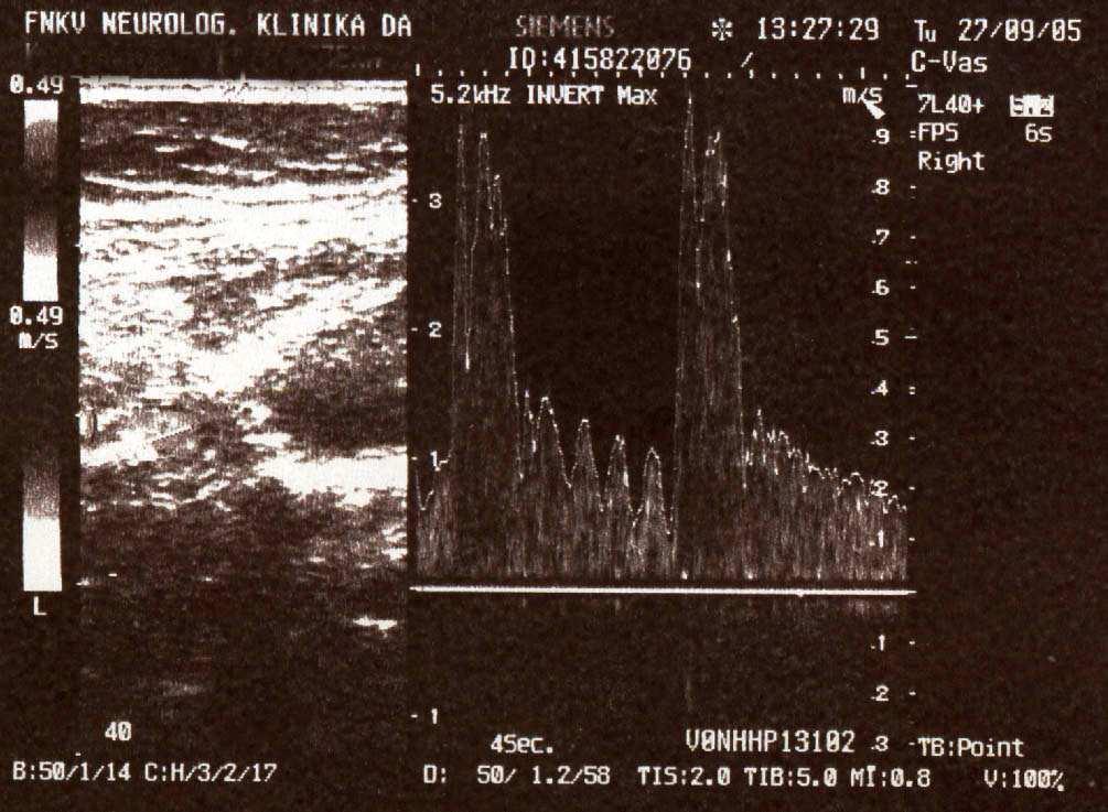 3. Vyšetření cév ultrazvukem Vnější karotida je charakteristická nízkou diastolickou rychlostí a vyšším RI.
