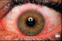 4.5.2.2. Akutní zarudnutí oka Akutní zarudnutí oka ( Contact Lens Induced Red Eye ) CLARE je spojeno s prodlouženým nošením a je to akutní zánětlivá reakce na toxiny jakými jsou např.